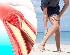 Phương Pháp Phòng Ngừa Xơ Vữa Động Mạch 2 bdmnv1