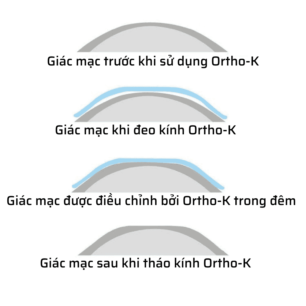 Tìm Hiểu Về Ortho-K 1 Cơ chế của Ortho-K