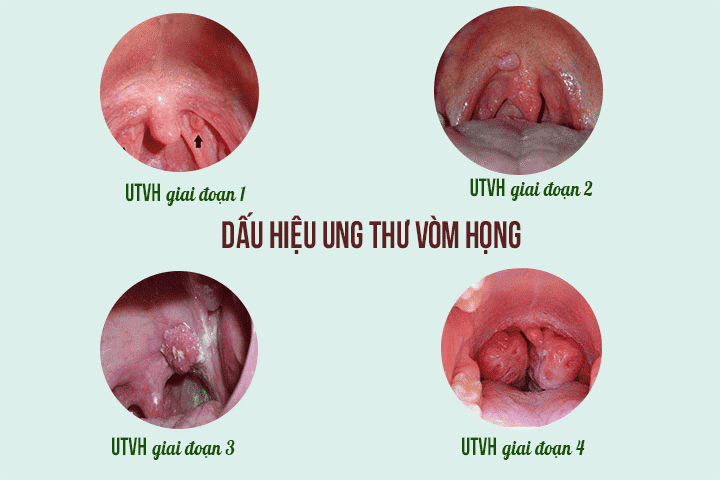 Ung Thư Vòm Họng - Nguyên Nhân Và Triệu Chứng 3 Các giai đoạn ung thư vòm họng