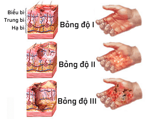 Làm Gì Khi Bị Bỏng? 2 Nhận biết các mức độ bỏng