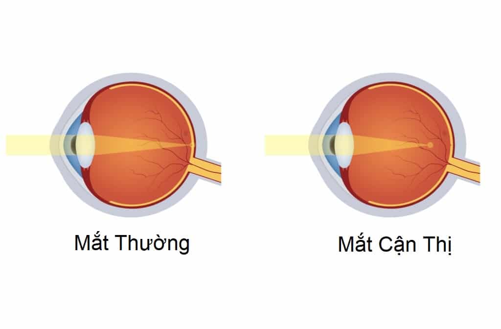 Cận Thị Và Cách Khắc Phục 1 Mắt thường so với mắt bị cận thị