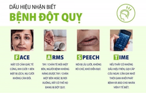 Các Phương Pháp Phòng Tránh Đột Quỵ 3 Các dấu hiệu báo trước của đột quỵ