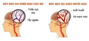 Các Phương Pháp Phòng Tránh Đột Quỵ 1 Phân loại đột quỵ