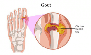 Bệnh Gout - Nguyên Nhân và Triệu Chứng 1 Sự hình thành của bệnh Gout
