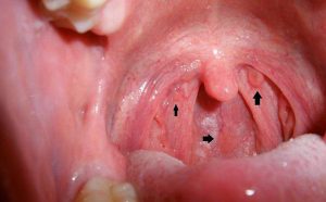 Ung Thư Vòm Họng - Nguyên Nhân Và Triệu Chứng 1 Những khối u do ung thư vòm họng