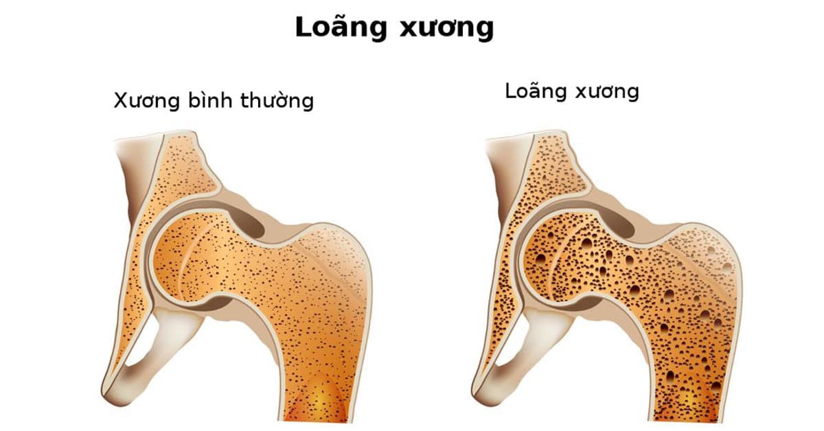 Loãng Xương - Nguyên Nhân và Triệu Chứng 1 Xương bị loãng so với xương bình thường