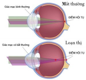 Loạn Thị Và Cách Khắc Phục 1 Mắt thường so với mắt bị loạn thị