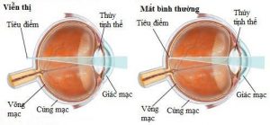 Viễn Thị Và Cách Khắc Phục 1 Mắt viễn thị so với mắt bình thường