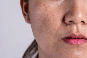 Nám Da Từ Đâu Mà Có 1 Vết nám da gây mất thẩm mỹ