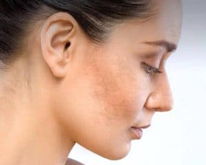 nam da nguyen nhan va cach khac phuc