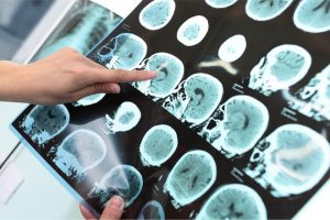 Alzheimer - Nguyên Nhân và Triệu Chứng 1 Ảnh chụp X-quang Alzheimer