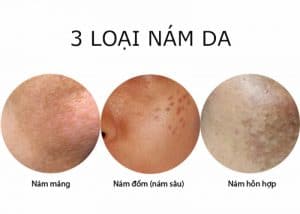 Nám Da Từ Đâu Mà Có 2 3 loại Nám Da