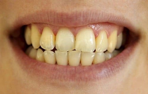 Vì Sao Răng Bị Xỉn Màu? 1 Răng bị xỉn màu