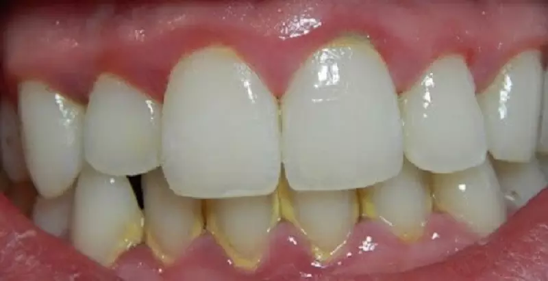 Sâu Răng - Nguyên Nhân và Triệu Chứng 2 Mảng bám răng