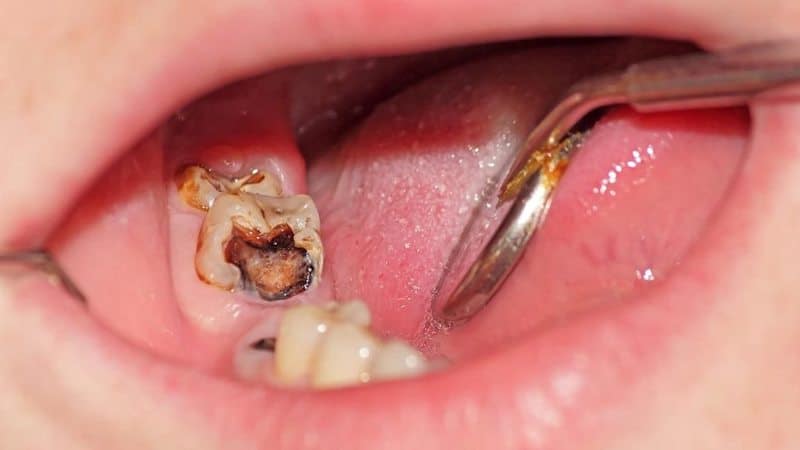 Sâu Răng - Nguyên Nhân và Triệu Chứng 1 Sâu răng
