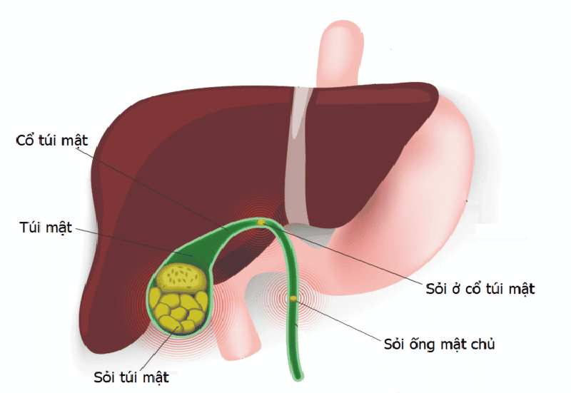 Sỏi Mật - Nguyên Nhân và Triệu Chứng 1 Sỏi hình thành trong túi mật