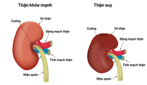Những Kiến Thức Cơ Bản Về Suy Thận 1 suy thận