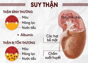 Những Kiến Thức Cơ Bản Về Suy Thận 2 suy thận làm giảm mạnh chức năng lọc máu