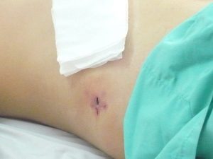 Phát Hiện Và Điều Trị Viêm Ruột Thừa 4 Vết mổ sau phẫu thuật nội soi