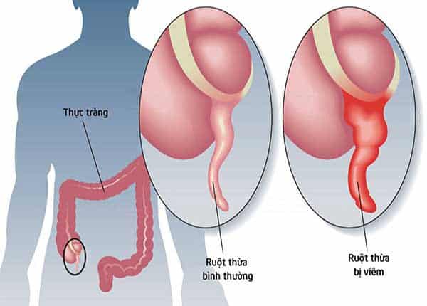 Phát Hiện Và Điều Trị Viêm Ruột Thừa 1 Hình ảnh Viêm ruột thừa