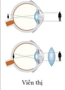 Viễn Thị Và Cách Khắc Phục 2 Mắt kính giúp người viễn thị cải thiện tầm nhìn