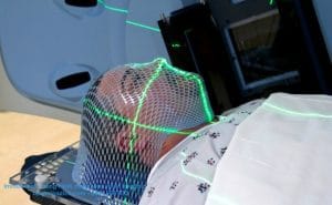 Ung Thư Vòm Họng - Nguyên Nhân Và Triệu Chứng 4 Xạ trị - Phương pháp cơ bản trong điều trị ung thư