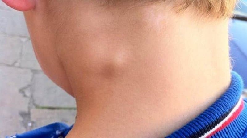 Nhận Biết Cảm Lạnh 2 Hạch bạch huyết bị sưng do cảm lạnh