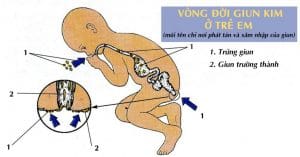 Nhận Biết Khi Cơ Thể Bị Nhiễm Ký Sinh Trùng 3 Ký sinh trùng giun kim
