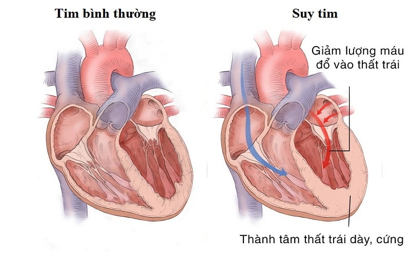 Suy Tim - Nguyên Nhân Và Triệu Chứng 1 Suy tim