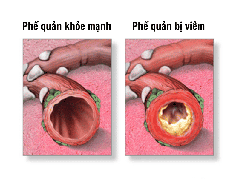 Viêm Phế Quản - Nguyên Nhân và Triệu Chứng 1 Phế quản bình thường vs Viêm phế quản