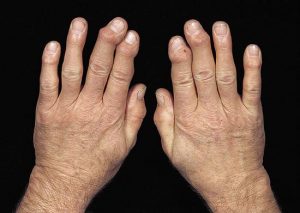 Tìm Hiểu Về Thoái Hóa Khớp 2 Sưng đốt ngón tay do thoái hóa khớp