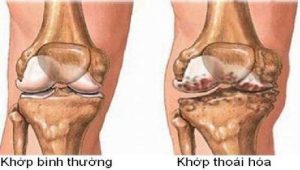Tìm Hiểu Về Thoái Hóa Khớp 1 So sánh thoái hóa khớp