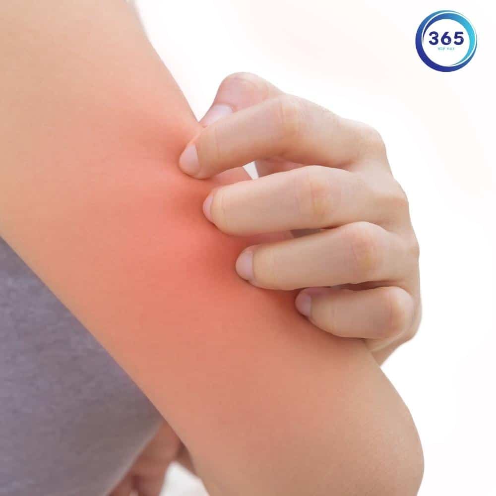 Dấu hiệu cảnh báo gan bạn có vấn đề 5 Nổi mề đay hay ngứa râm ran là dấu hiệu gan bạn đang yếu