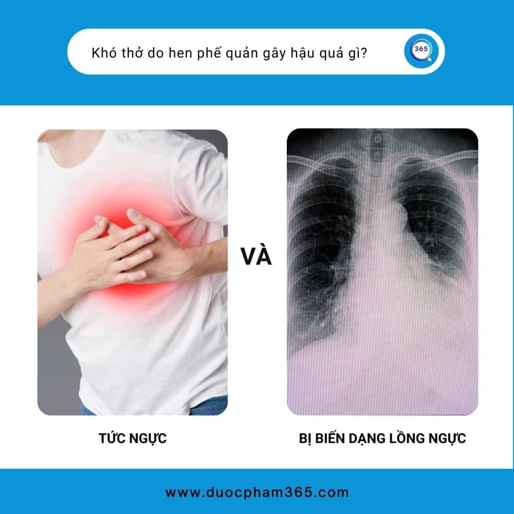 Bài tập thở giúp người hen phế quản cải thiện tình trạng bệnh 2 hau qua cua hen suyen