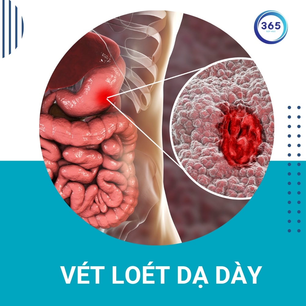 Loét dạ dày và tá tràng