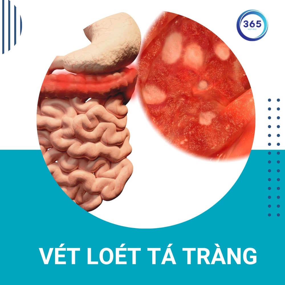 loet ta trang