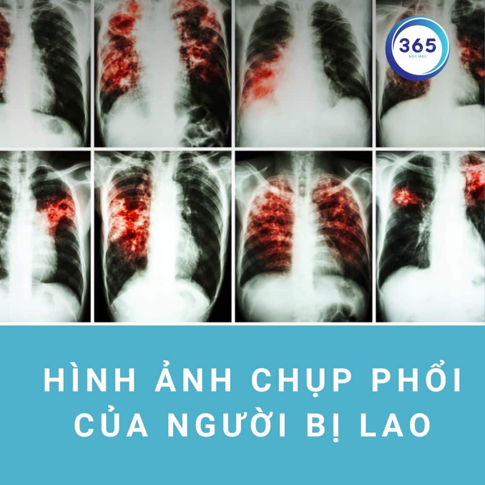 Bệnh lao - Nguyên nhân và cách điều trị 3 phoi bi lao