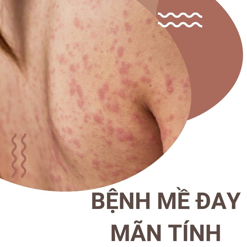 Mề đay mãn tính nguyên nhân do đâu 1 Bệnh mề đay mãn tính là gì