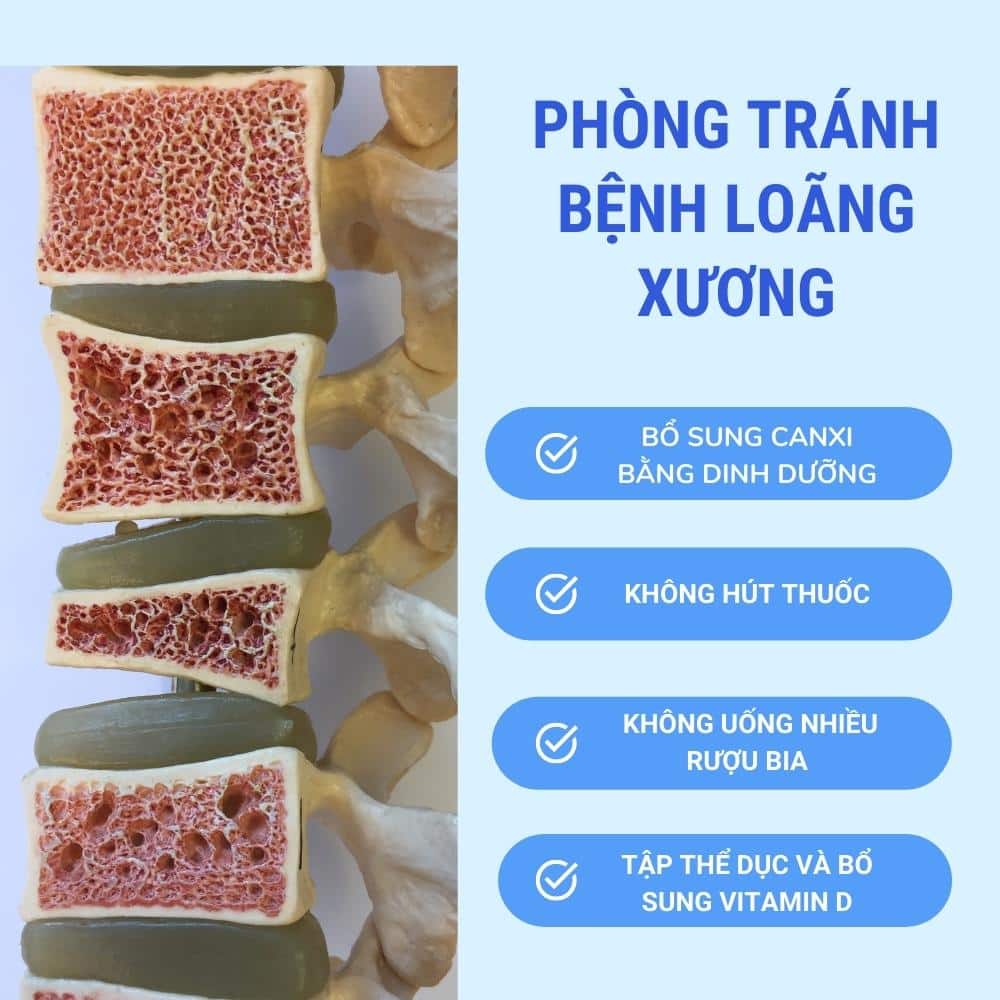 Loãng xương là gì? Ai nên kiểm tra loãng xương? 4 cach phong tranh loang