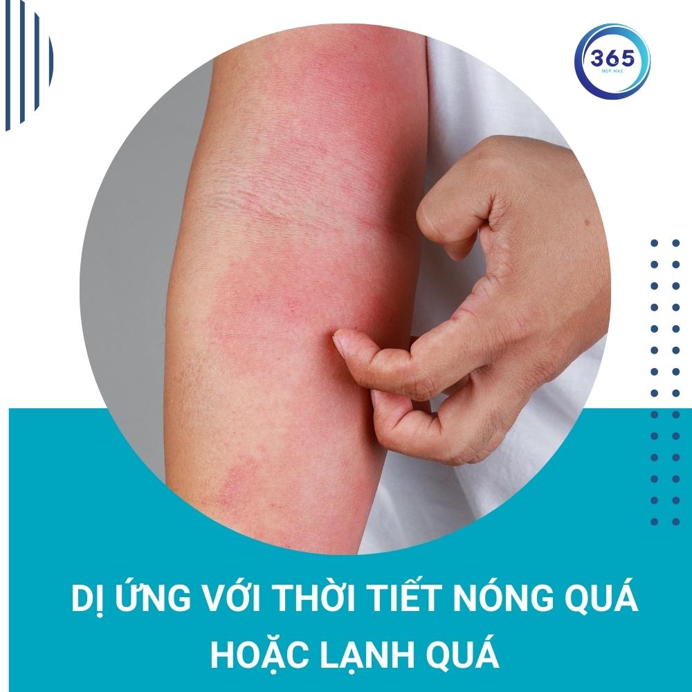 Mề đay mãn tính nguyên nhân do đâu 3 di ung thoi tiet