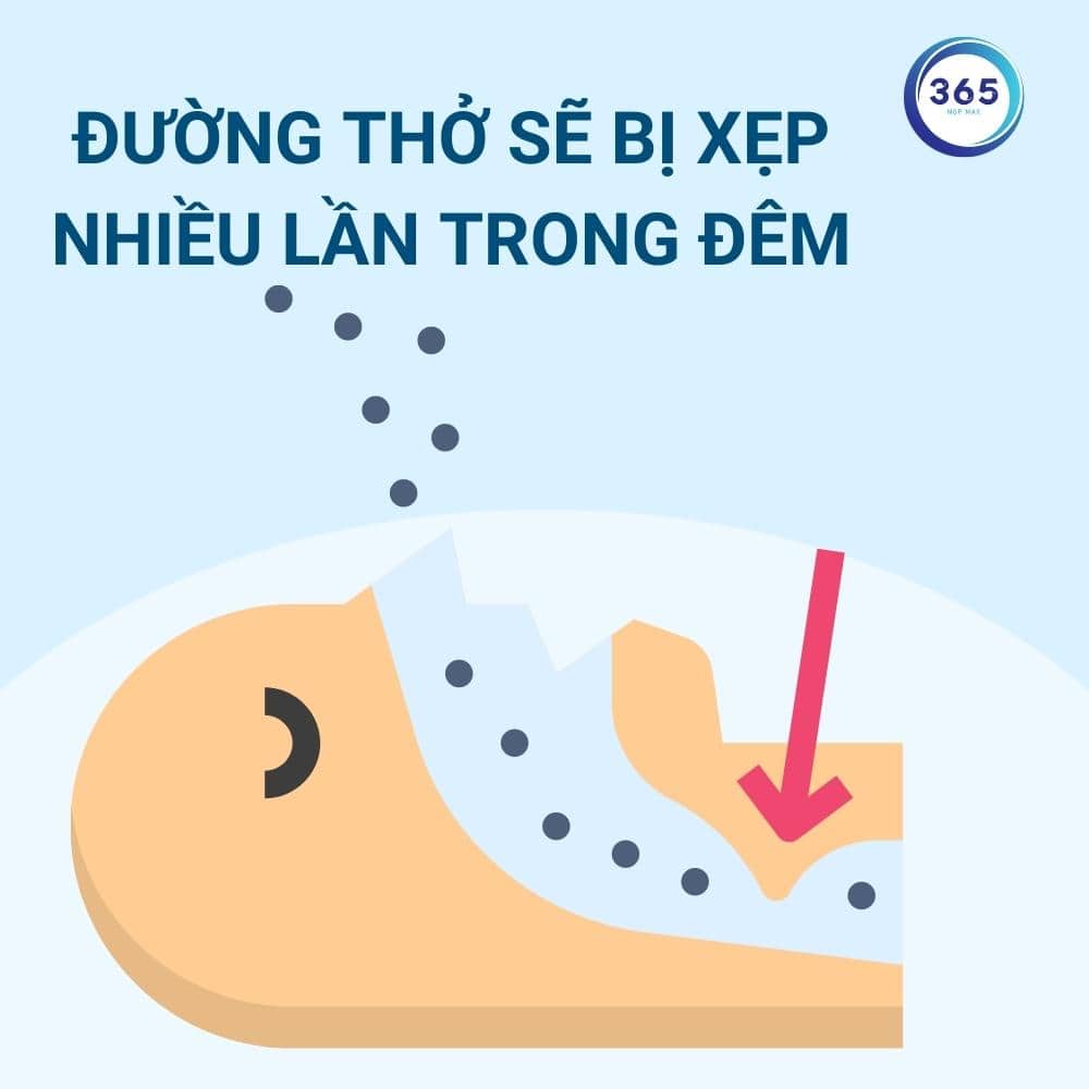 Chứng ngưng thở khi ngủ là gì? 4 duong tho bi xep khi ngu
