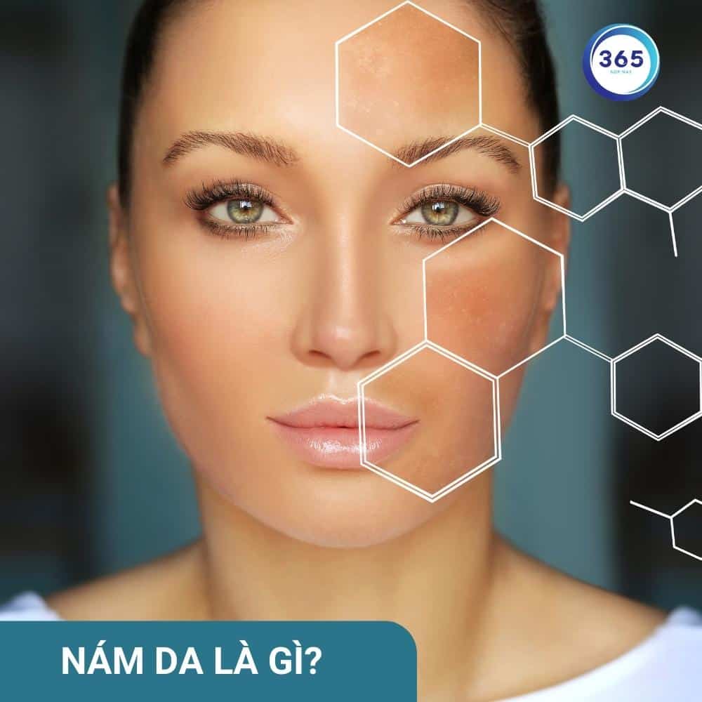 Bí kíp làm đẹp: 5 Cách trị nám da tại gia 1 Nám da là gì?