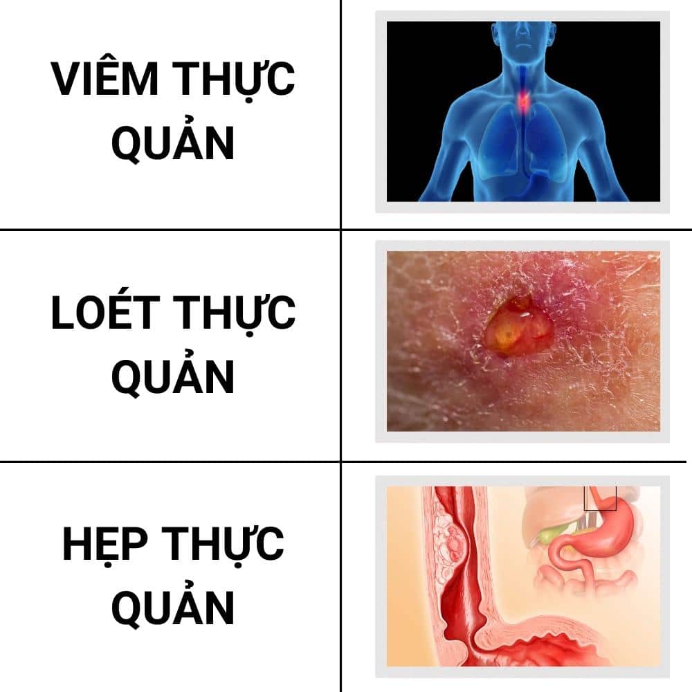 Nguy cơ ung thư từ bệnh trào ngược dạ dày