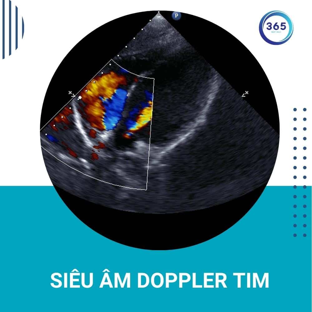 sieu am doppler tim