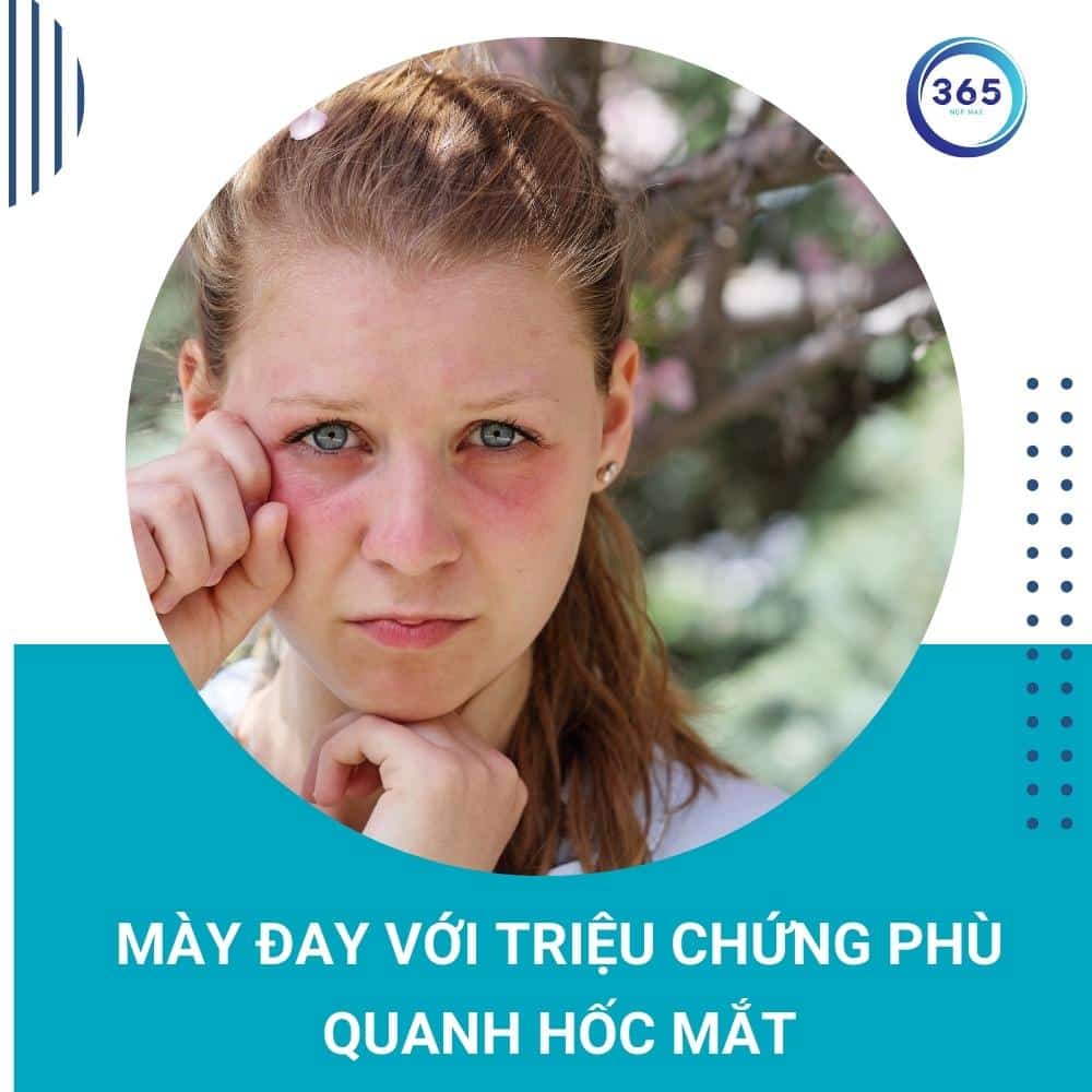 Mề đay mãn tính nguyên nhân do đâu 2 trieu chung may day