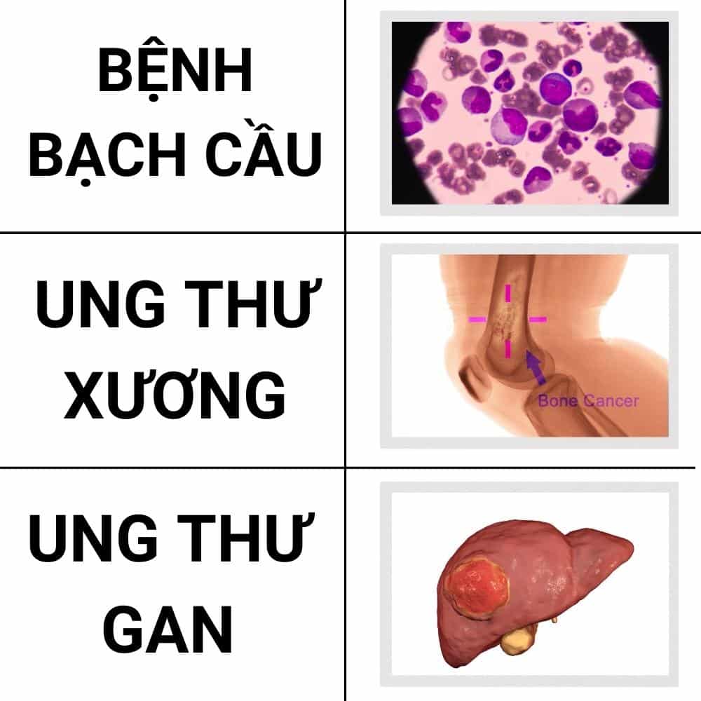 các loại bệnh khi bị đổ mồ hôi đêm