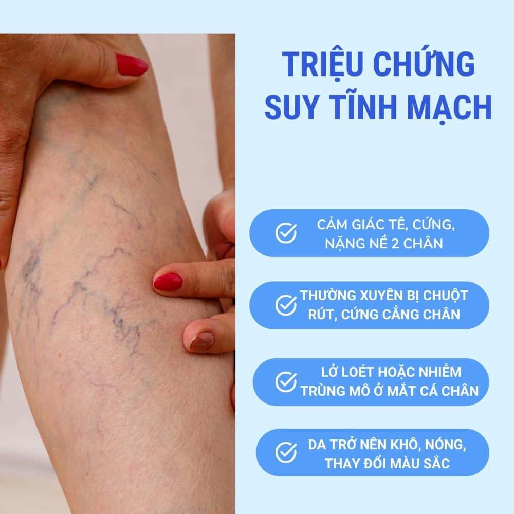 Suy tĩnh mạch là gì? 3 cac trieu chung suy tinh mach