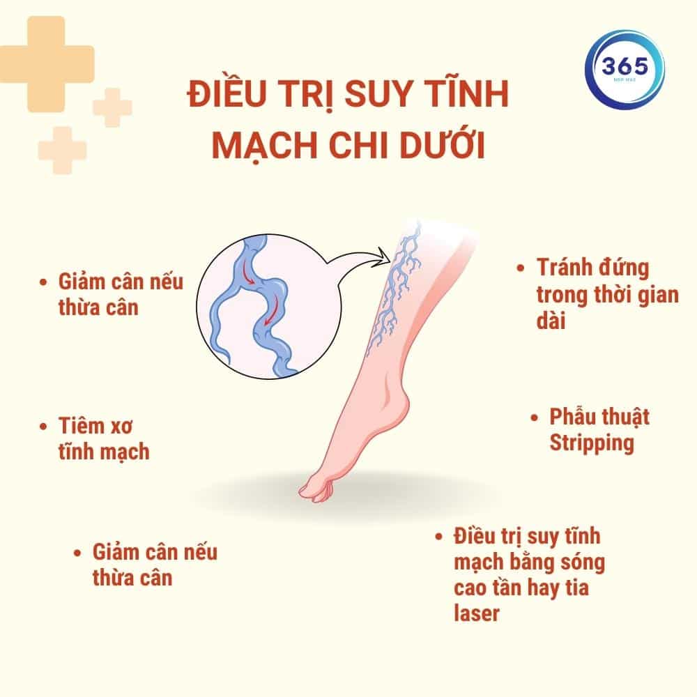 Suy tĩnh mạch là gì? 4 dieu tri suy tinh mach