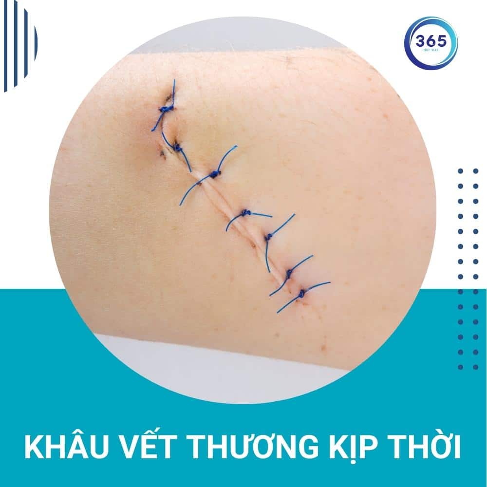 khau vet thuong kip thoi