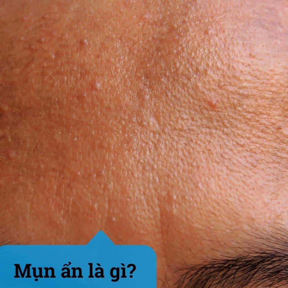 Mụn ẩn trên da